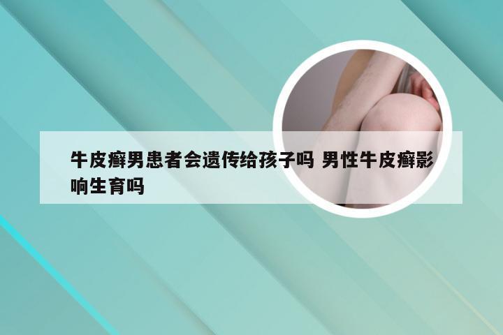 牛皮癣男患者会遗传给孩子吗 男性牛皮癣影响生育吗