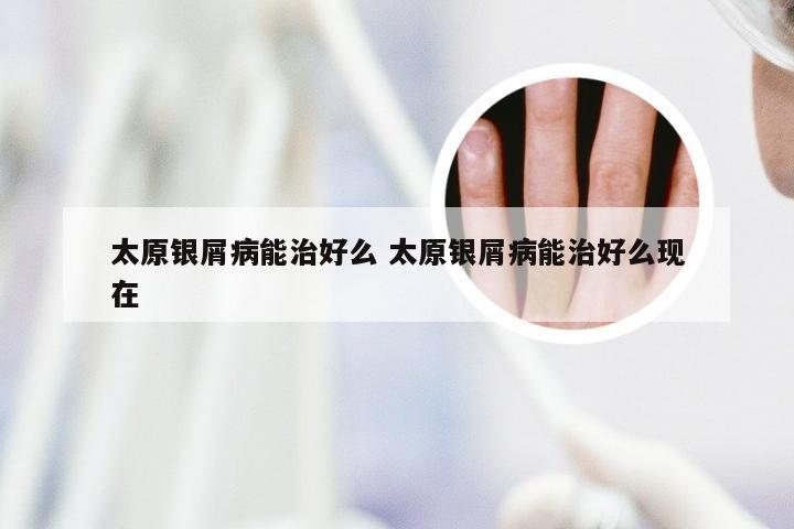 太原银屑病能治好么 太原银屑病能治好么现在