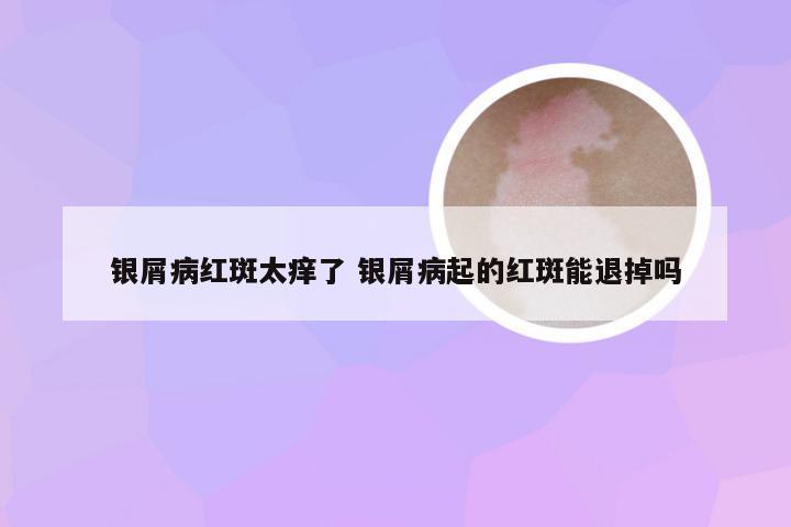 银屑病红斑太痒了 银屑病起的红斑能退掉吗
