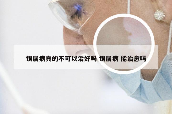 银屑病真的不可以治好吗 银屑病 能治愈吗