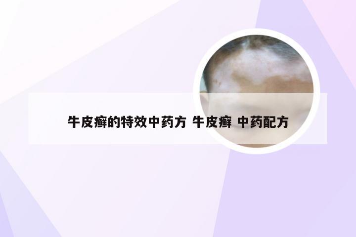 牛皮癣的特效中药方 牛皮癣 中药配方