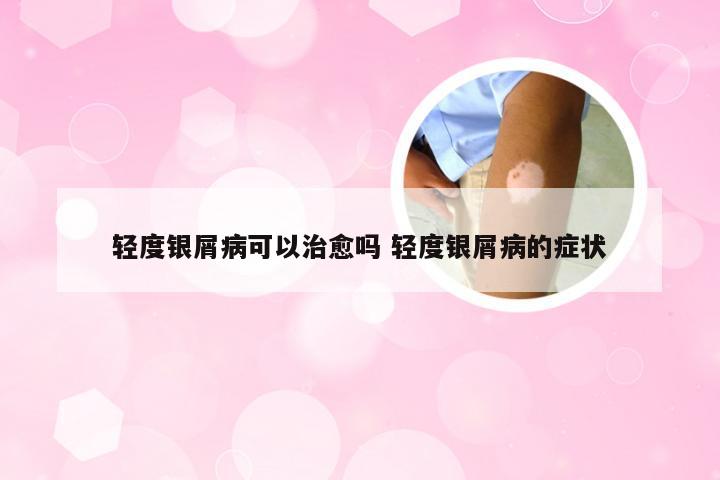 轻度银屑病可以治愈吗 轻度银屑病的症状