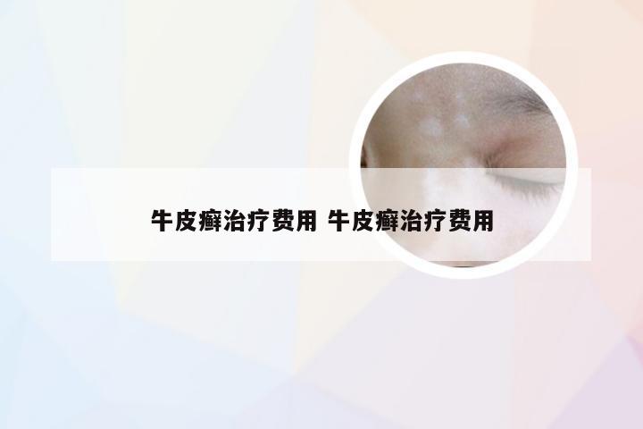 牛皮癣治疗费用 牛皮癣治疗费用