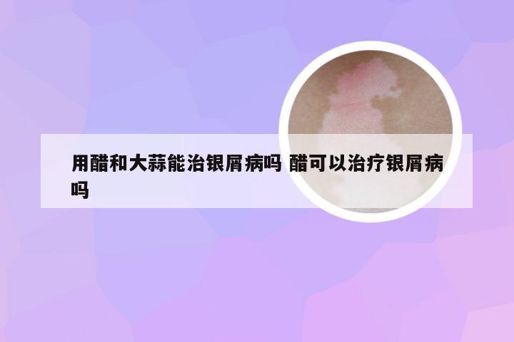 用醋和大蒜能治银屑病吗 醋可以治疗银屑病吗