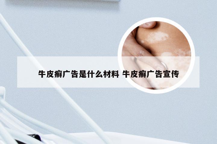 牛皮癣广告是什么材料 牛皮癣广告宣传
