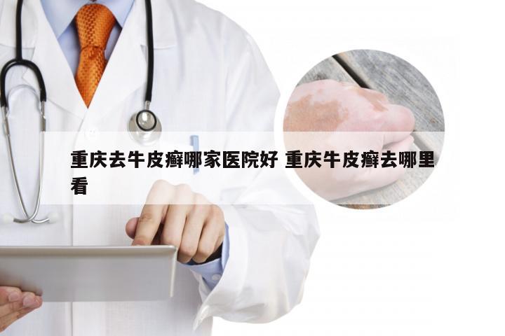 重庆去牛皮癣哪家医院好 重庆牛皮癣去哪里看