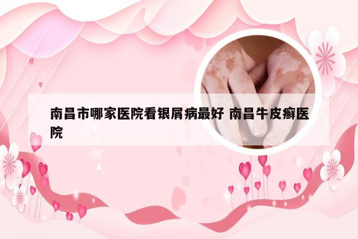 南昌市哪家医院看银屑病最好 南昌牛皮癣医院