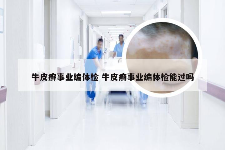 牛皮癣事业编体检 牛皮癣事业编体检能过吗