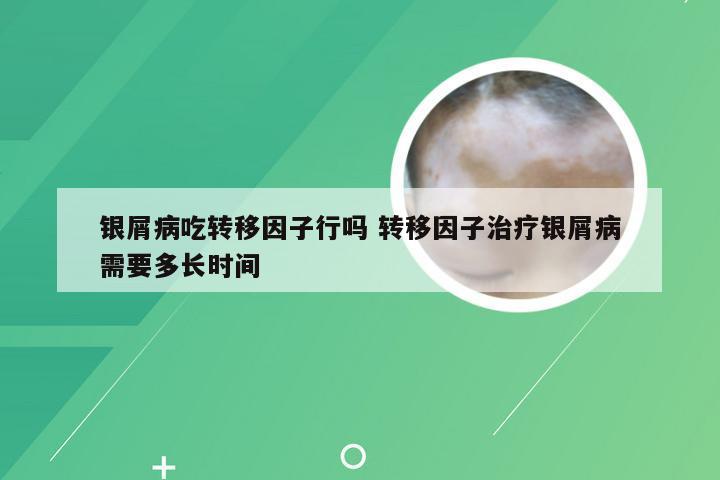 银屑病吃转移因子行吗 转移因子治疗银屑病需要多长时间