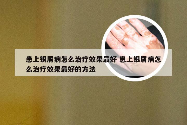 患上银屑病怎么治疗效果最好 患上银屑病怎么治疗效果最好的方法