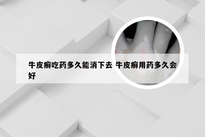牛皮癣吃药多久能消下去 牛皮癣用药多久会好