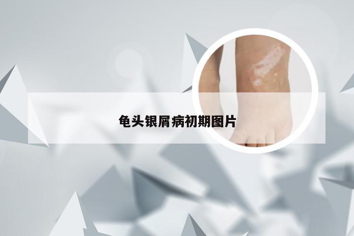 龟头银屑病初期图片