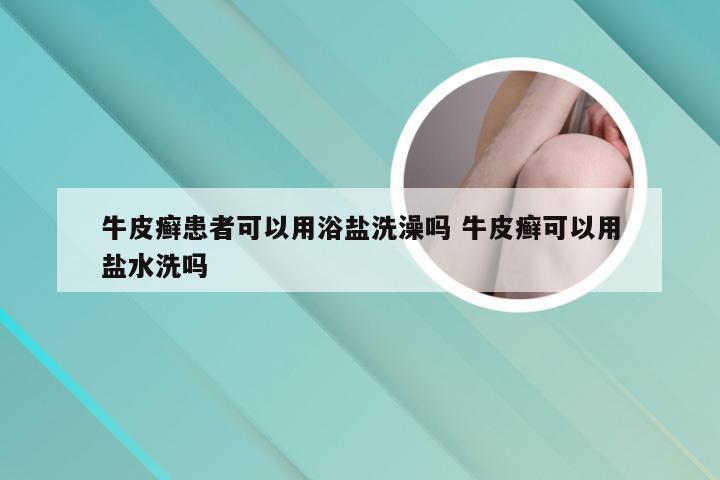 牛皮癣患者可以用浴盐洗澡吗 牛皮癣可以用盐水洗吗