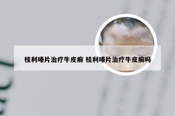 桂利嗪片治疗牛皮癣 桂利嗪片治疗牛皮癣吗