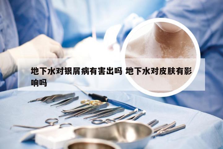 地下水对银屑病有害出吗 地下水对皮肤有影响吗