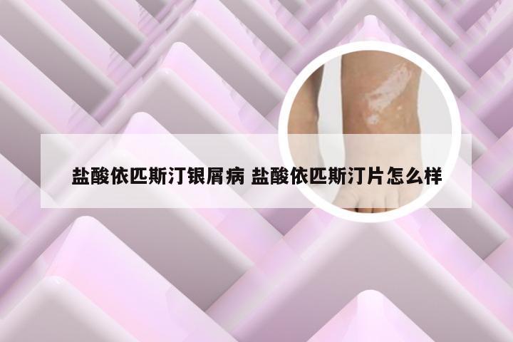 盐酸依匹斯汀银屑病 盐酸依匹斯汀片怎么样
