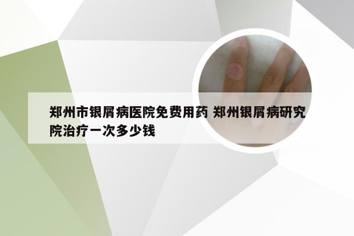 郑州市银屑病医院免费用药 郑州银屑病研究院治疗一次多少钱
