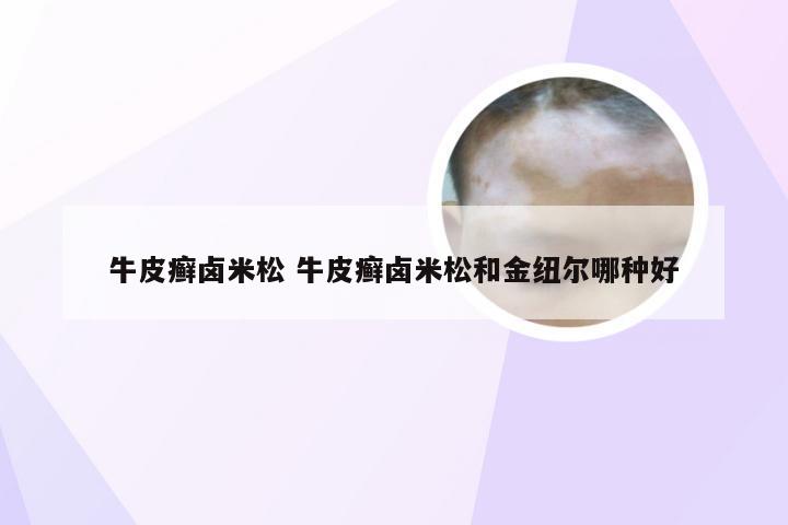 牛皮癣卤米松 牛皮癣卤米松和金纽尔哪种好