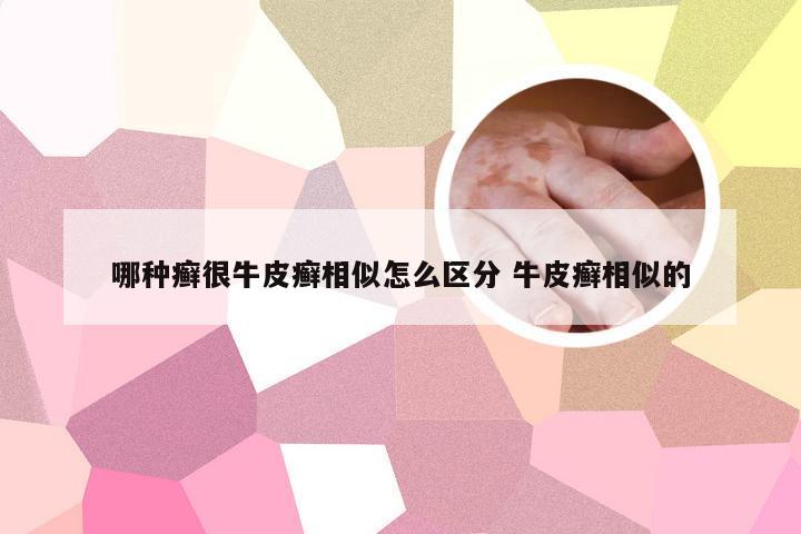 哪种癣很牛皮癣相似怎么区分 牛皮癣相似的