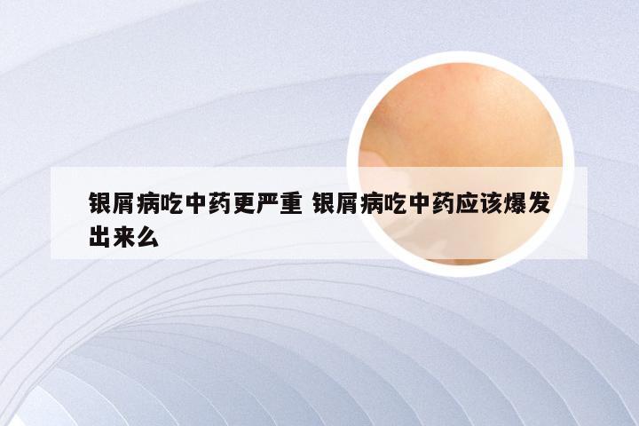 银屑病吃中药更严重 银屑病吃中药应该爆发出来么