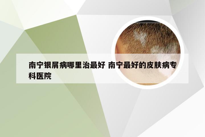 南宁银屑病哪里治最好 南宁最好的皮肤病专科医院