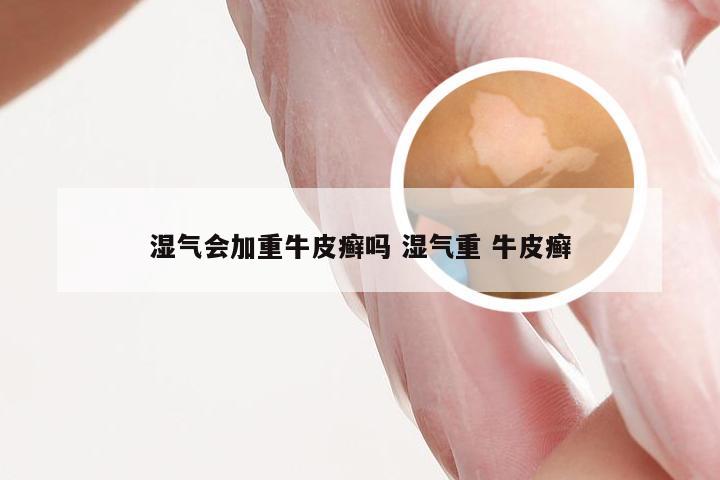 湿气会加重牛皮癣吗 湿气重 牛皮癣