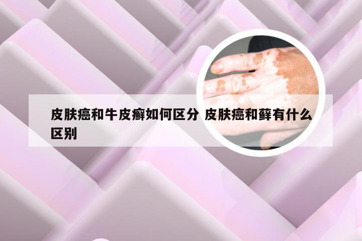 皮肤癌和牛皮癣如何区分 皮肤癌和藓有什么区别