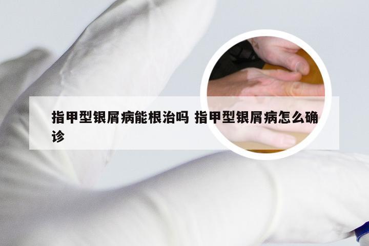 指甲型银屑病能根治吗 指甲型银屑病怎么确诊