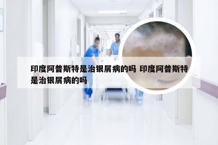 印度阿普斯特是治银屑病的吗 印度阿普斯特是治银屑病的吗