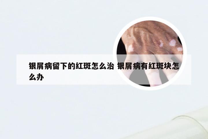 银屑病留下的红斑怎么治 银屑病有红斑块怎么办