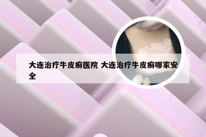 大连治疗牛皮癣医院 大连治疗牛皮癣哪家安全