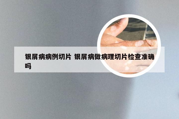 银屑病病例切片 银屑病做病理切片检查准确吗