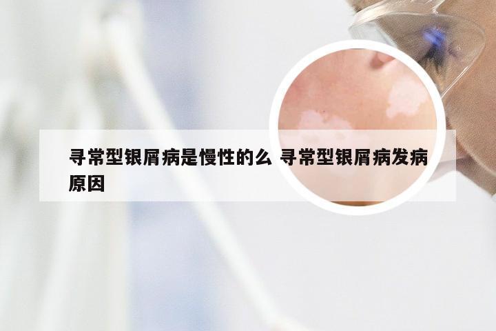 寻常型银屑病是慢性的么 寻常型银屑病发病原因