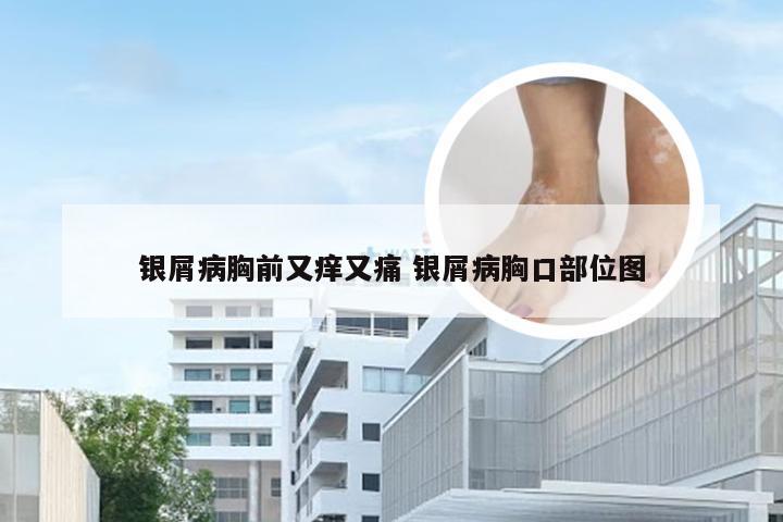 银屑病胸前又痒又痛 银屑病胸口部位图