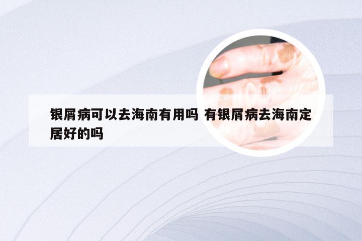 银屑病可以去海南有用吗 有银屑病去海南定居好的吗