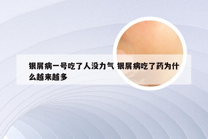 银屑病一号吃了人没力气 银屑病吃了药为什么越来越多