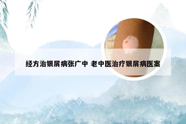 经方治银屑病张广中 老中医治疗银屑病医案