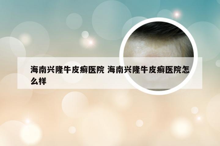 海南兴隆牛皮癣医院 海南兴隆牛皮癣医院怎么样