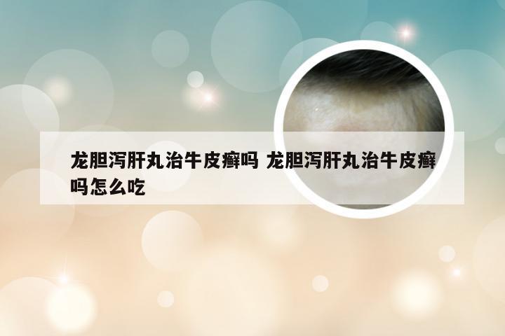 龙胆泻肝丸治牛皮癣吗 龙胆泻肝丸治牛皮癣吗怎么吃