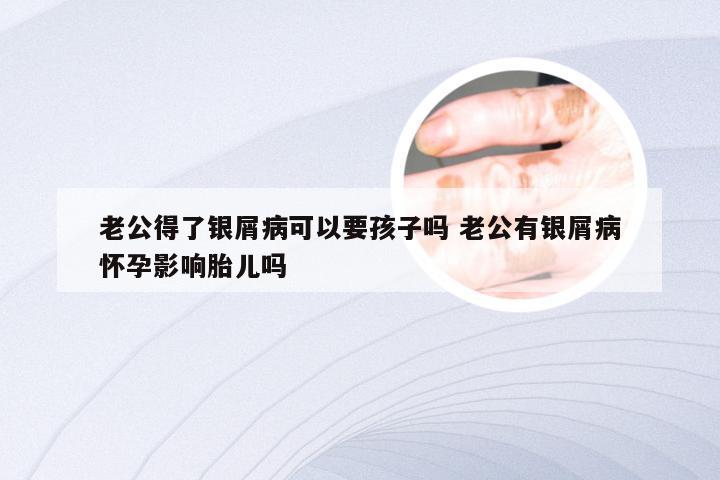老公得了银屑病可以要孩子吗 老公有银屑病怀孕影响胎儿吗