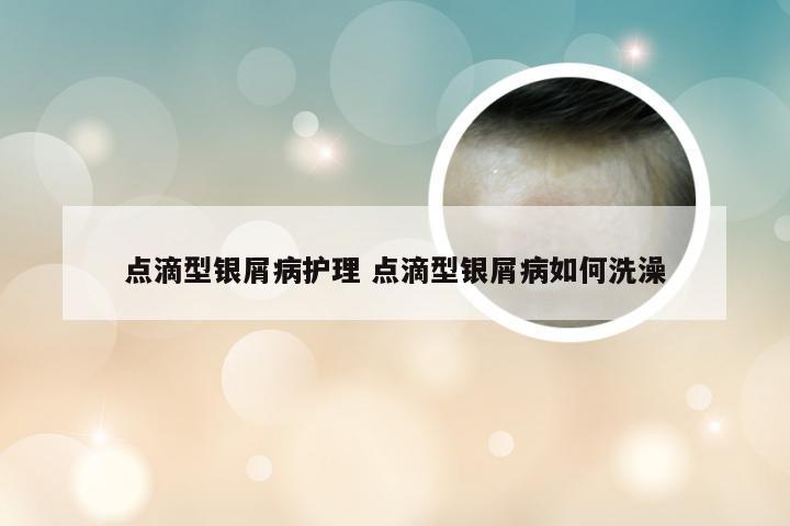 点滴型银屑病护理 点滴型银屑病如何洗澡