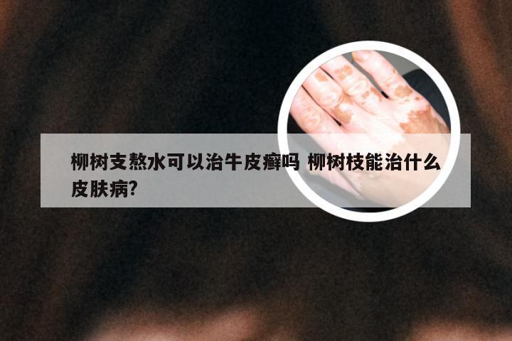 柳树支熬水可以治牛皮癣吗 柳树枝能治什么皮肤病?