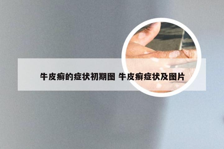 牛皮癣的症状初期图 牛皮癣症状及图片