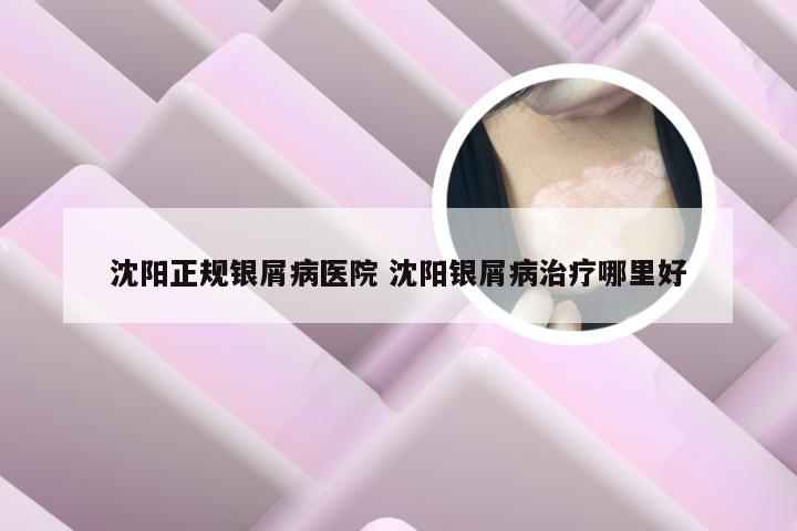沈阳正规银屑病医院 沈阳银屑病治疗哪里好