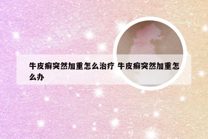 牛皮癣突然加重怎么治疗 牛皮癣突然加重怎么办