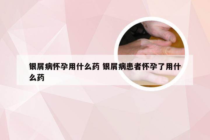 银屑病怀孕用什么药 银屑病患者怀孕了用什么药