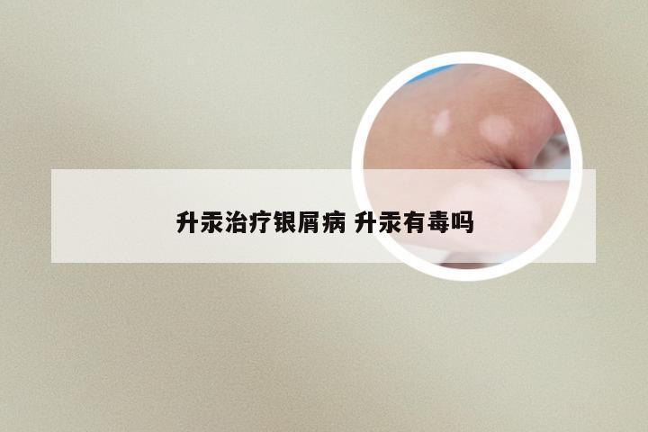 升汞治疗银屑病 升汞有毒吗