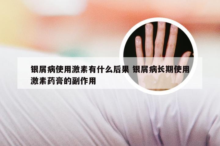 银屑病使用激素有什么后果 银屑病长期使用激素药膏的副作用