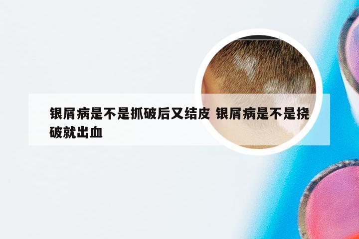 银屑病是不是抓破后又结皮 银屑病是不是挠破就出血