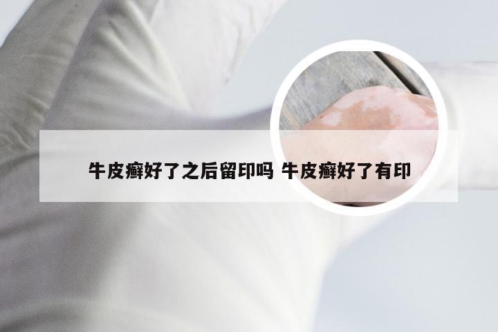 牛皮癣好了之后留印吗 牛皮癣好了有印